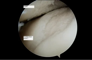 soort astroscope op de knie gewricht met artrose van de 3de graad