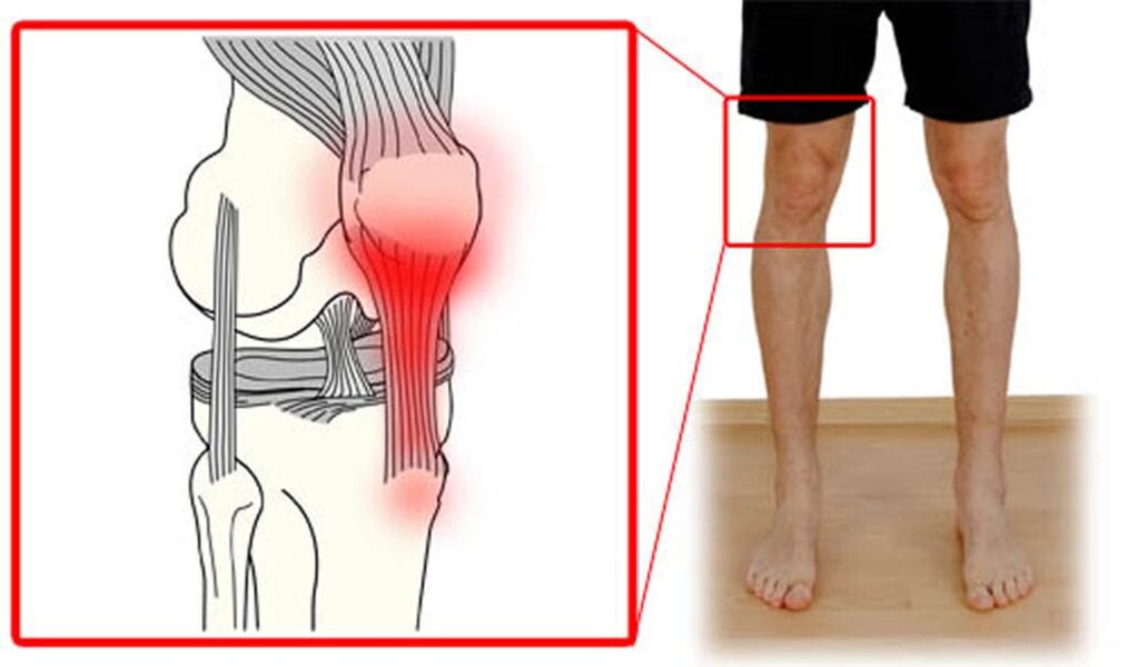 Tendinitis - ontsteking van de pezen in het kniegewricht