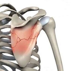 Fractuur van de scapula is een van de oorzaken van hevige pijn