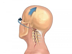 hoe osteochondrose van de cervicale wervelkolom zich manifesteert