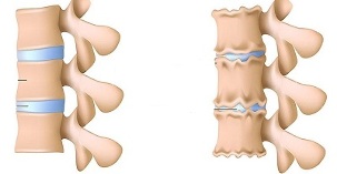 hoe de aanwezigheid van osteochondrose van de lumbale wervelkolom te herkennen