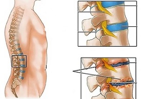 oorzaken van osteochondrose van de lumbale wervelkolom