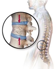 Osteoporose veroorzaakt rugpijn in de lumbale regio