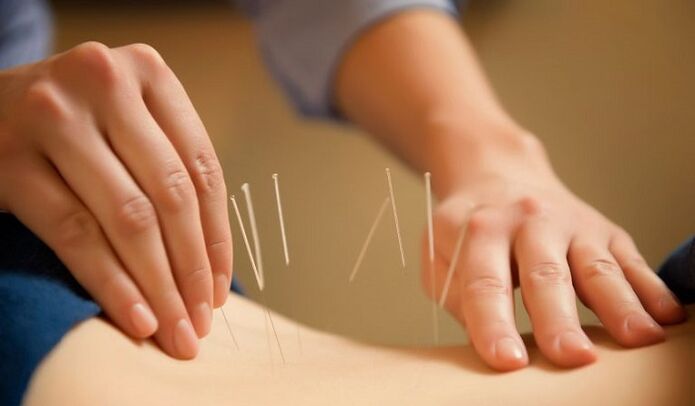 acupunctuur om lage rugpijn te behandelen